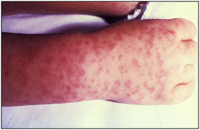 Rocky Mountian spotted fever rash